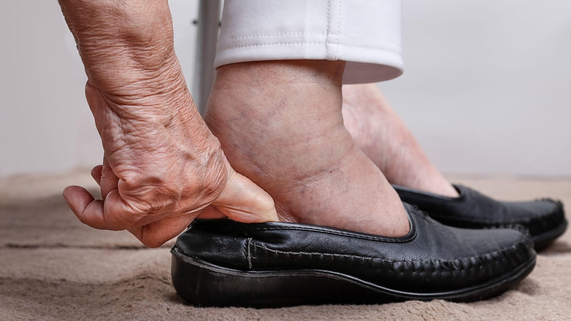 peripheral-artery-disease-pad-swollen-feet