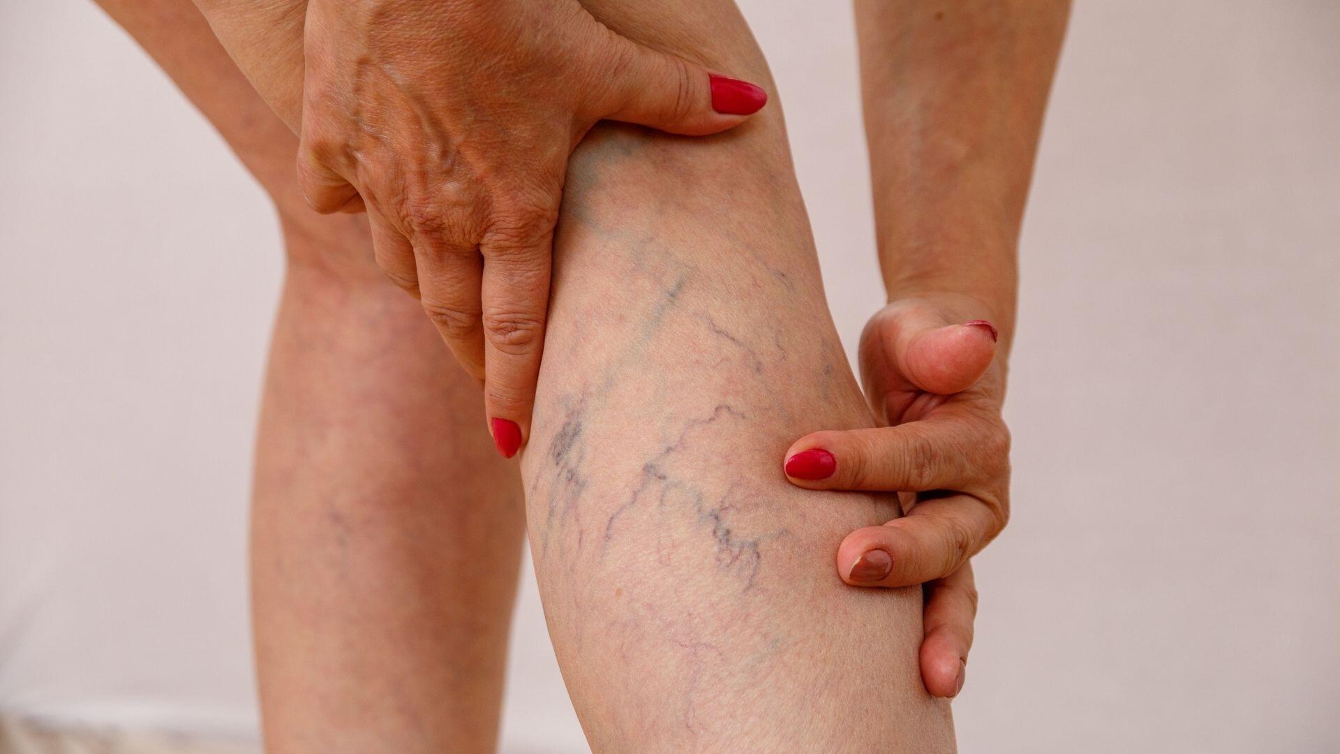 spider-vein-treatment-leg-pain