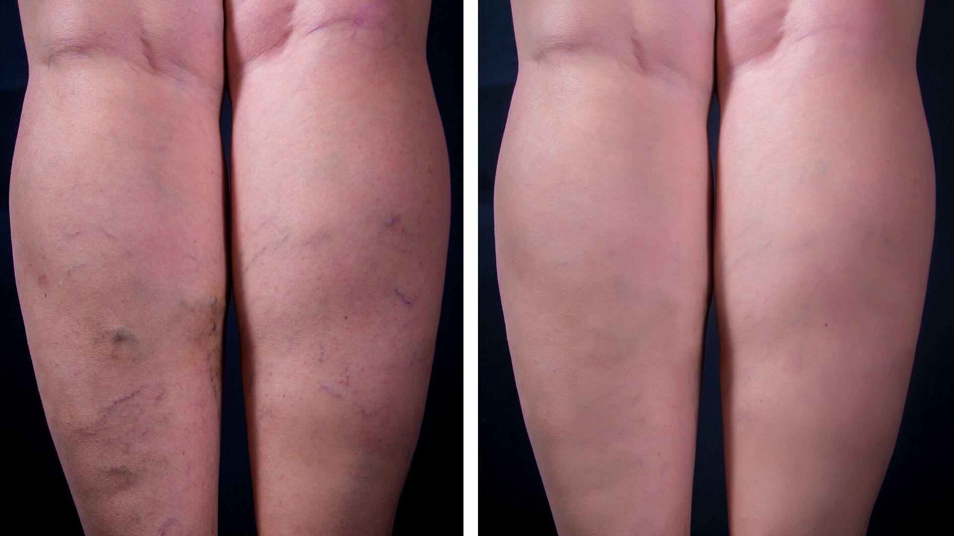 varicose-vein-before-after