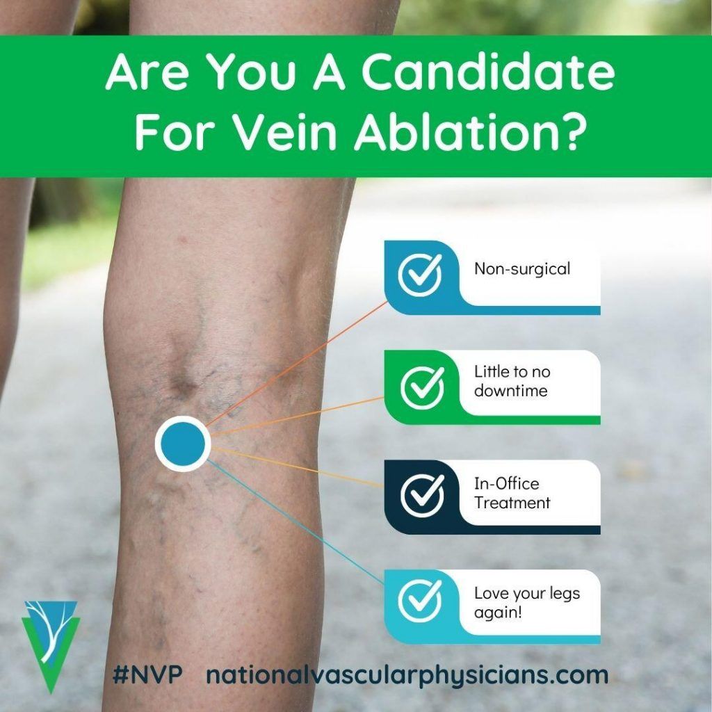Are You A Candidate For Vein Ablation