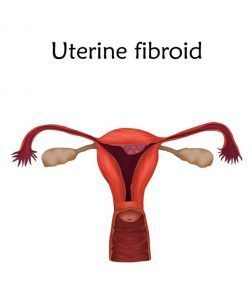 fibroids