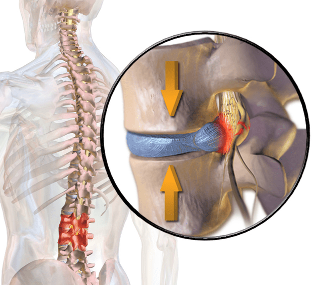 spinal compression fracture