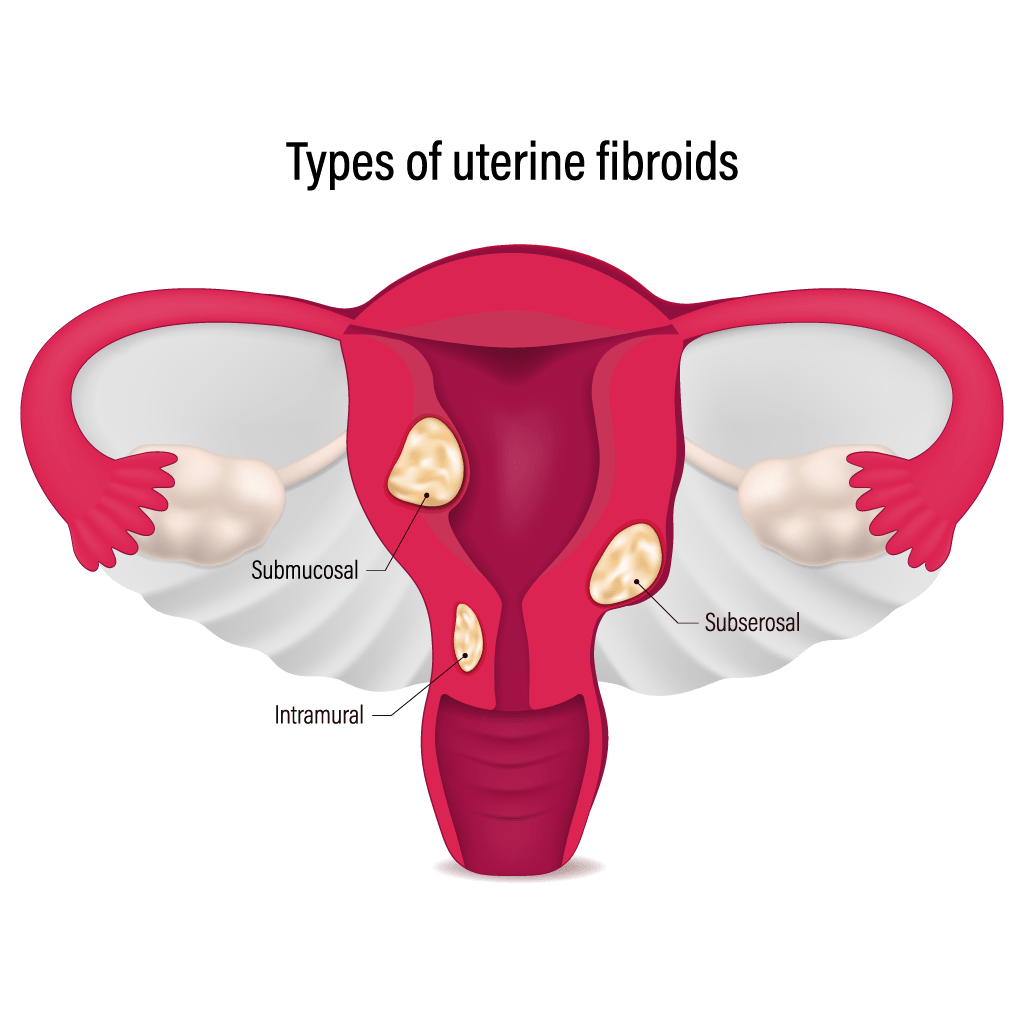 uterine-fibroids-uterus-ufe-illustration-1835148598 | National Vascular ...