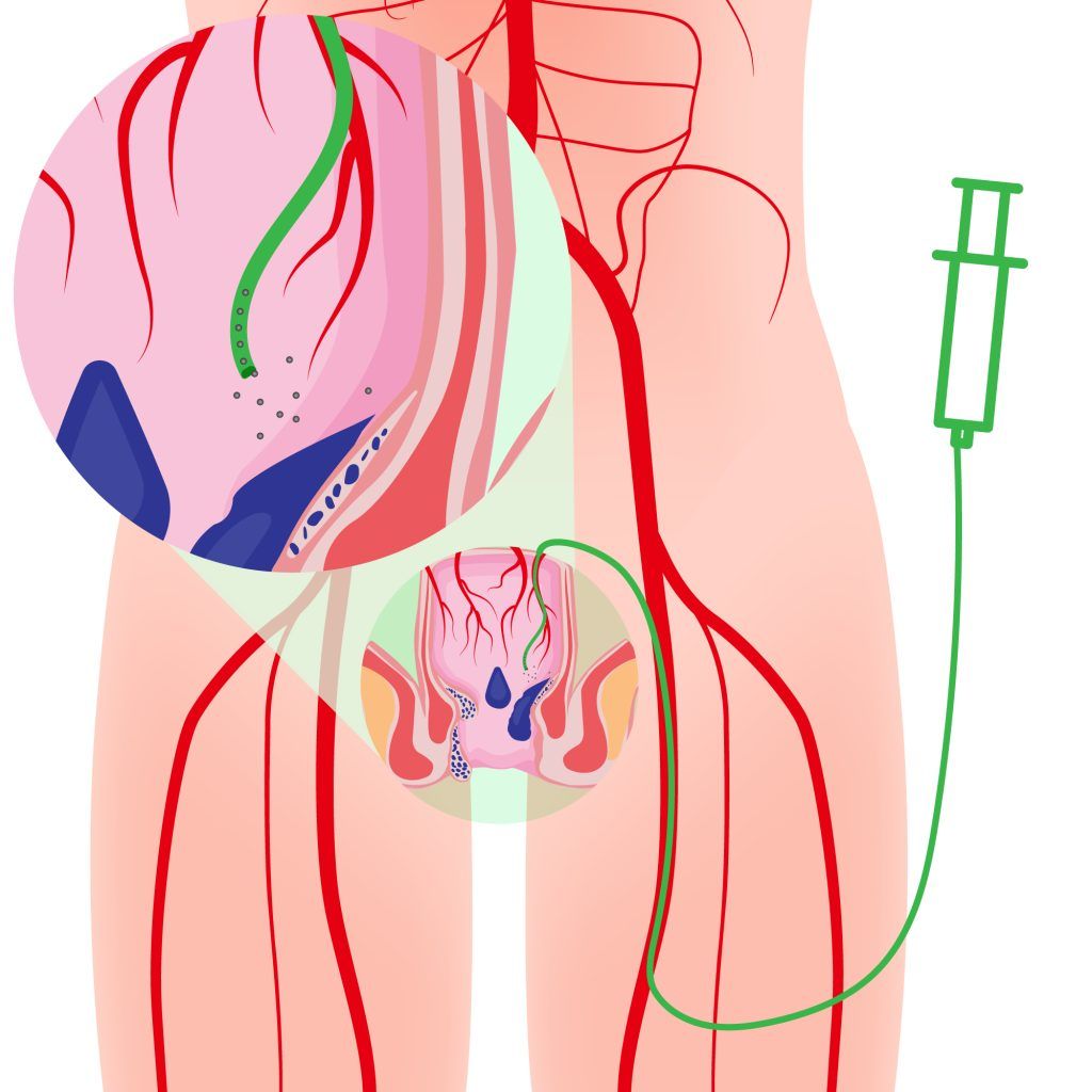 HAE-Procedure-Illustration-groin