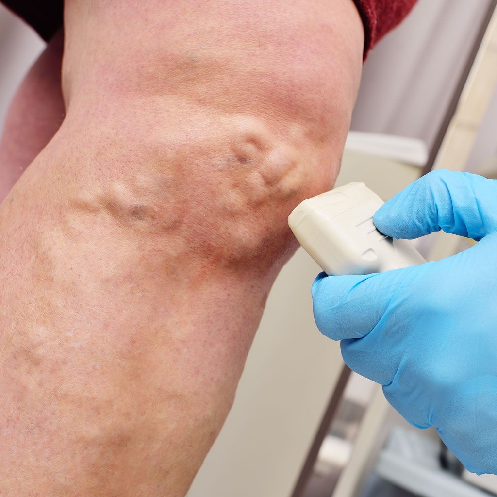 Varicose Vein Ultrasound