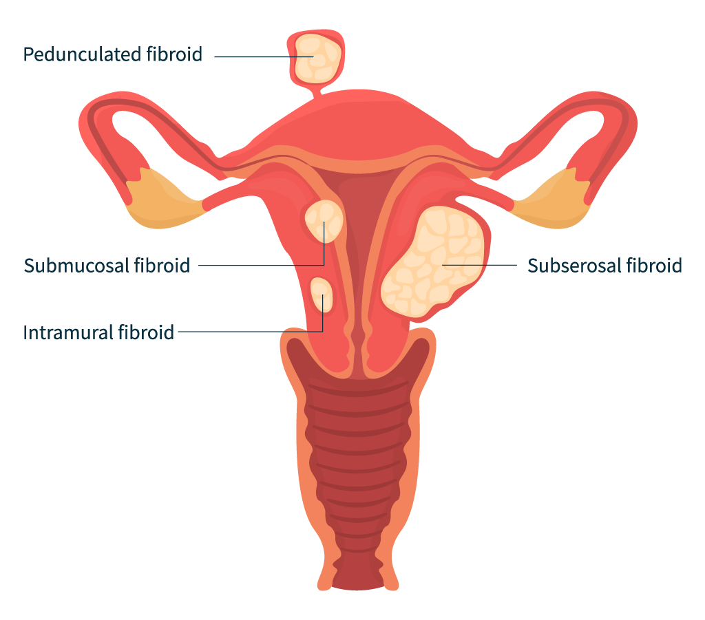 types of uterine fibroids