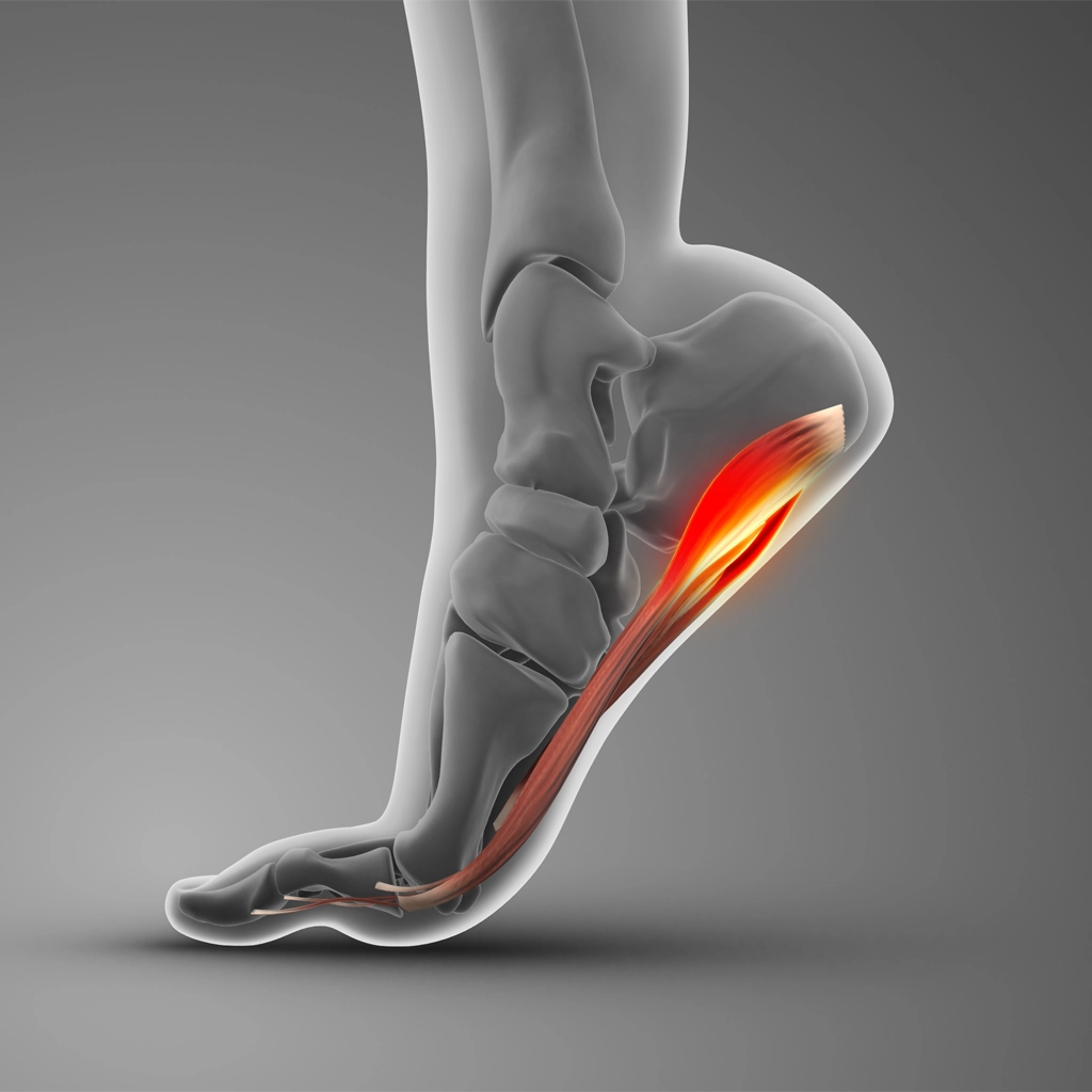 plantar fasciitis embolization