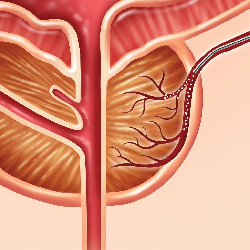 PAE - Prostate Artery Embolization PAE - Prostate Artery Embolization