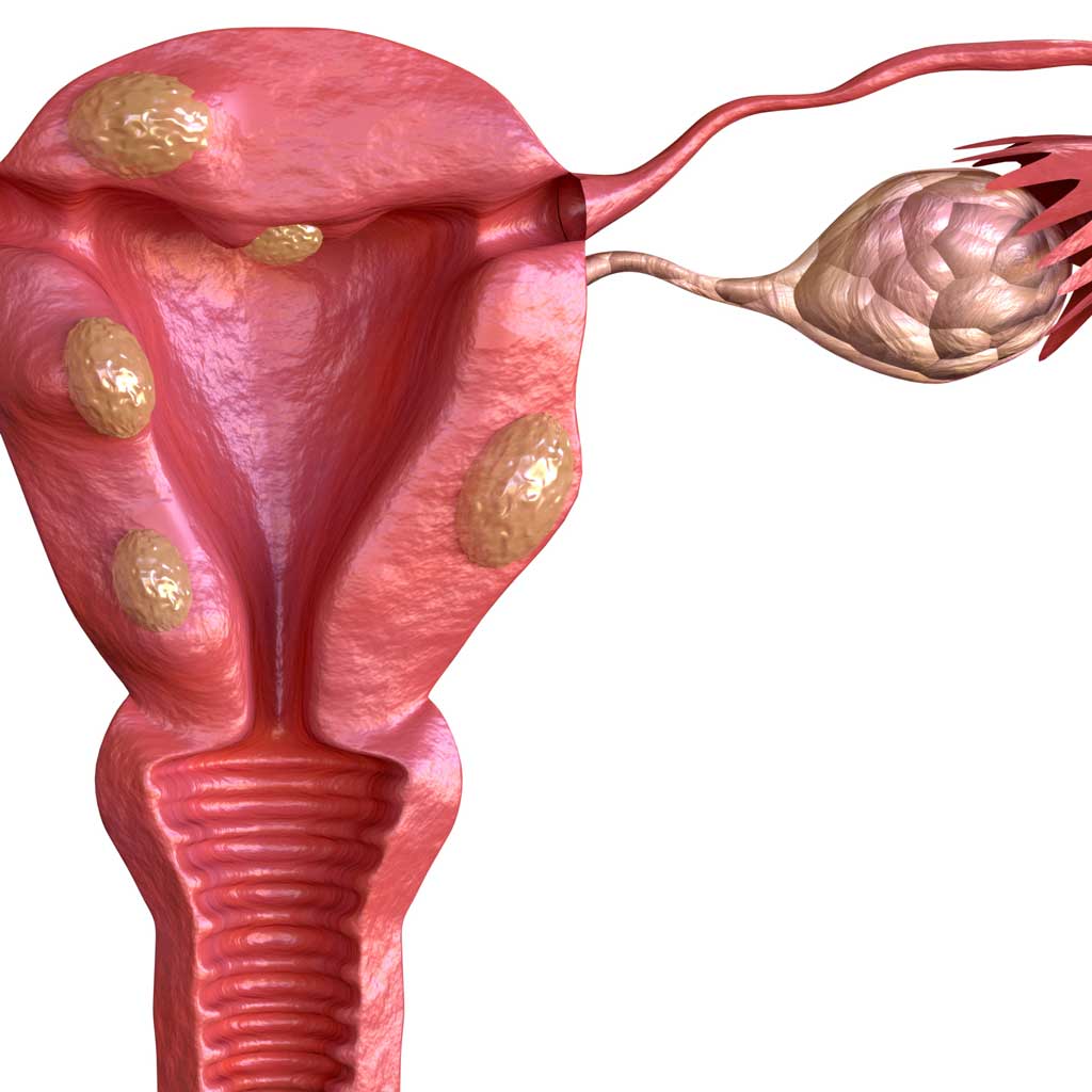 Uterine Fibroids Render