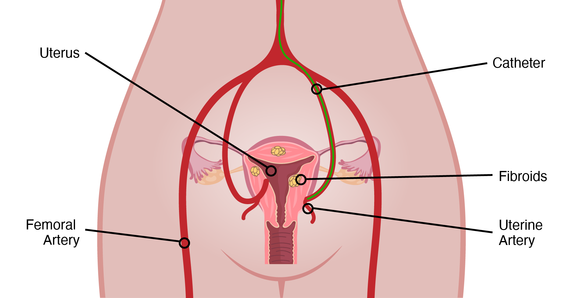 UFE-Prodecure-Illustration_v3