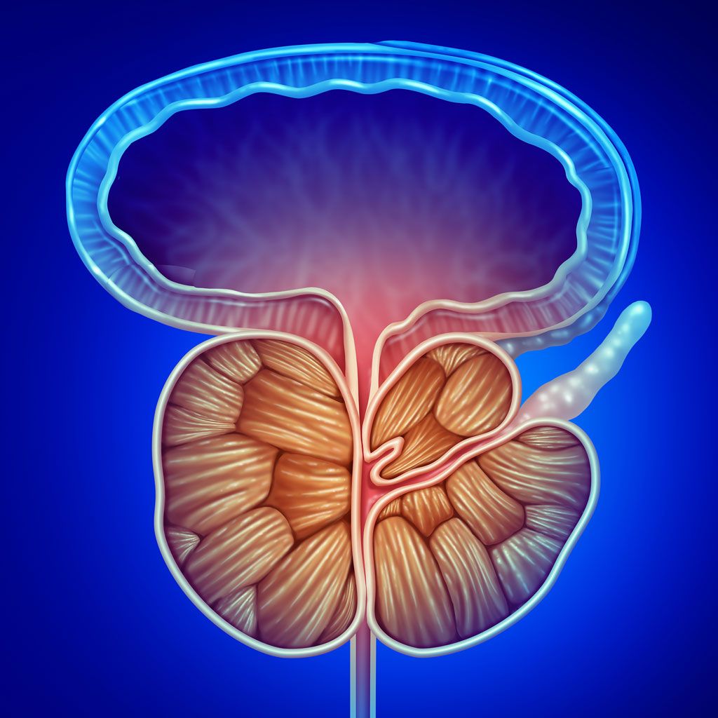 Enlarged Prostate