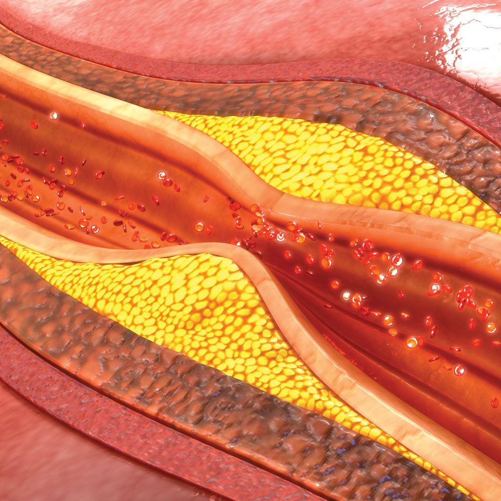 Peripheral Artery Disease Blocked Vein Illustration