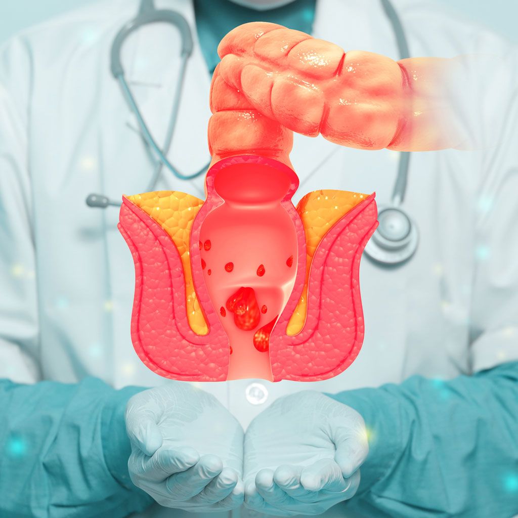 Doctor Holding Render for Hemorrhoid Artery Embolization